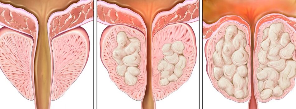 The level of prostatitis